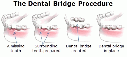 Dental Bridge